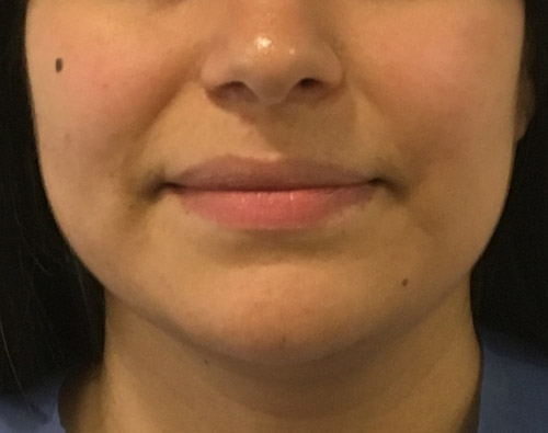 Adelgazamiento facial, bichectomía y Papada - Dr. Esteban Torres Cirujano Plástico Acreditado