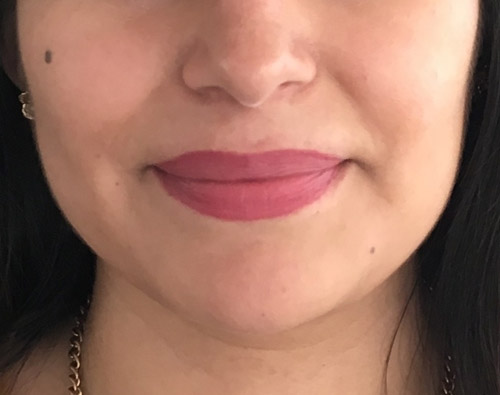 Adelgazamiento facial, bichectomía y Papada - Dr. Esteban Torres Cirujano Plástico Acreditado