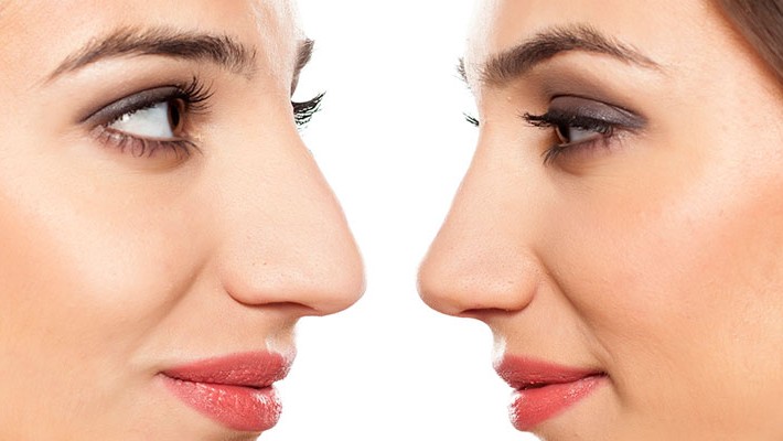 ¿Rinoplastía o Rinomodelación? Diferentes opciones para mejorar el aspecto de tu nariz, Dr. Esteban Torres