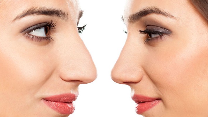 Close-up de mujer con nariz mejorada, mostrando resultados de rinoplastia por Dr. Esteban Torres | Cirujano Plástico Santi...