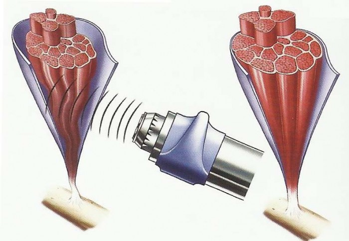 Tratamiento de ondas de choque contra la celulitis. Dr. Esteban Torres | Cirujano Plástico Santiago.