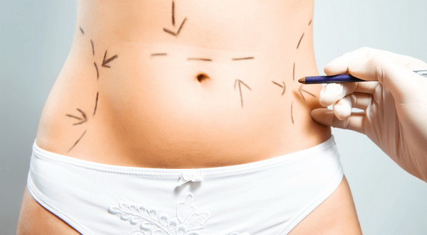 ¿Quieres saber más sobre la abdominoplastía?, Dr. Esteban Torres
