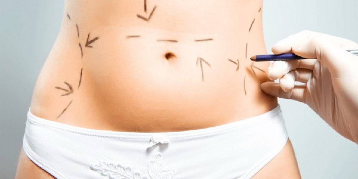 Abdominoplastia: la cirugía para obtener un abdomen plano que está ganando más adeptos, Dr. Esteban Torres Egaña
