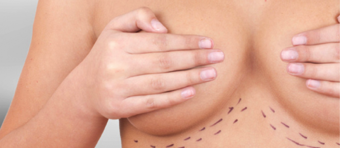Las mamas de tamaño excesivo pueden dañar tu espalda y… ¡también tu vida sexual!, Dr. Esteban Torres