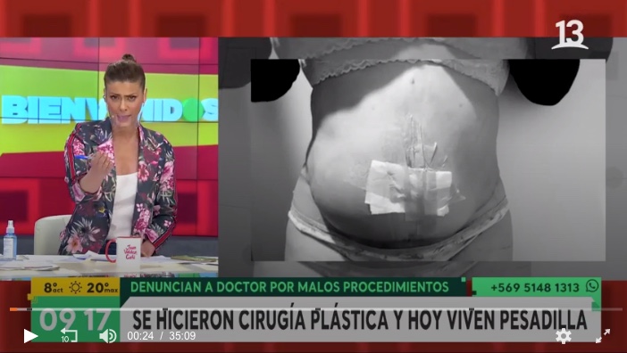 Dr. Esteban Torres en programa "Bienvenidos" discutiendo innovaciones en cirugía plástica. Cirujano en Santiago.