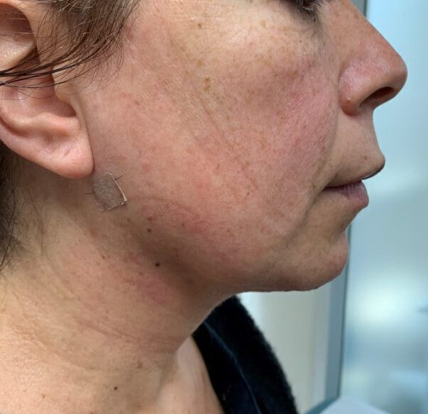 Lipoaspiración de papada - Dr. Esteban Torres Cirujano Plástico Acreditado Lipoaspiración de papada - Dr. Esteban Torres Cirujano Plástico Acreditado
