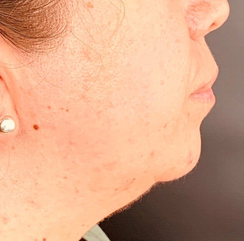Lipoaspiración de papada - Dr. Esteban Torres Cirujano Plástico Acreditado Lipoaspiración de papada - Dr. Esteban Torres Cirujano Plástico Acreditado