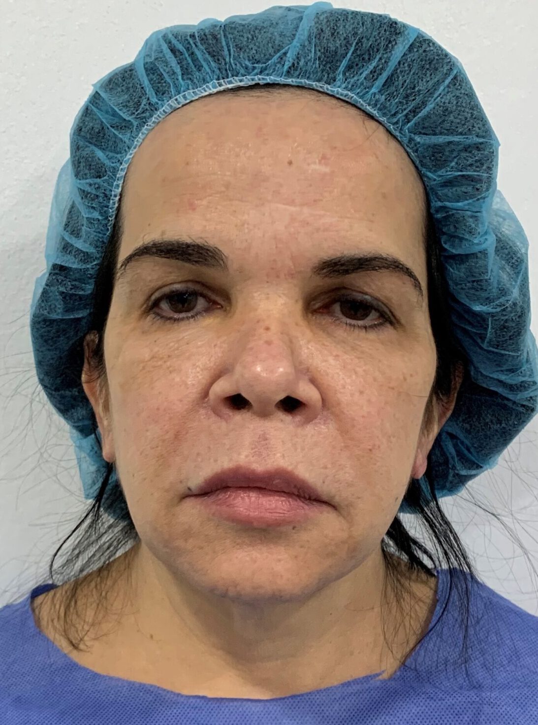 Lifting Facial - Dr. Esteban Torres Cirujano Plástico Acreditado