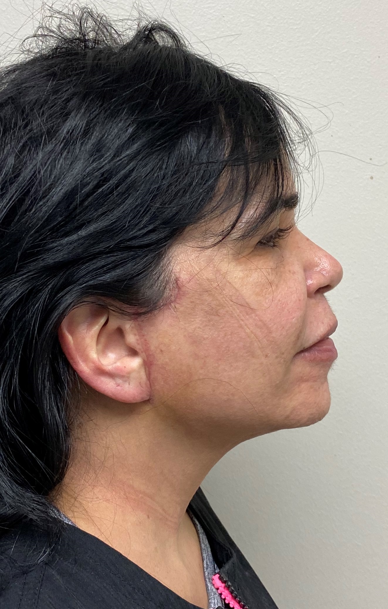 Lifting Facial - Dr. Esteban Torres Cirujano Plástico Acreditado
