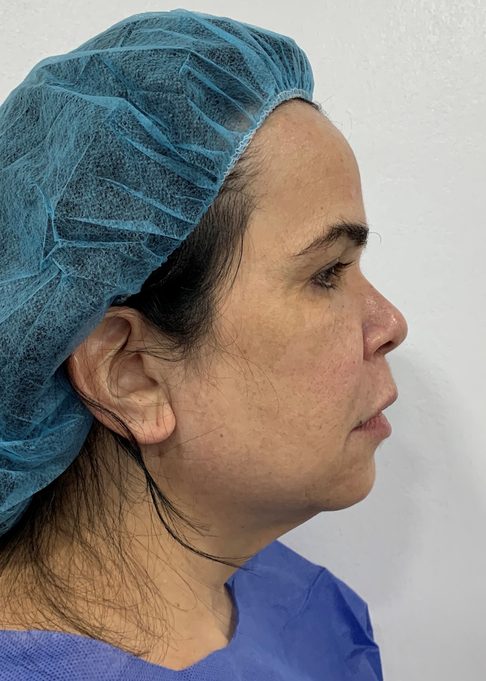 Lifting Facial - Dr. Esteban Torres Cirujano Plástico Acreditado